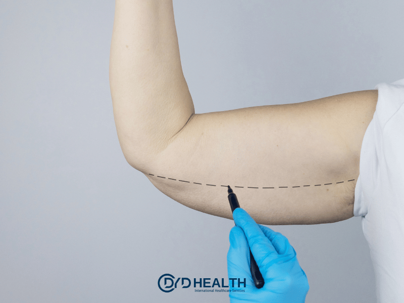 Kol Germe Ameliyatı