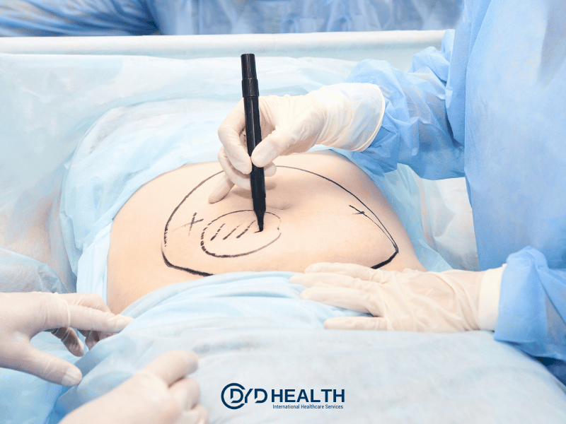Liposuction Nasıl Yapılır?