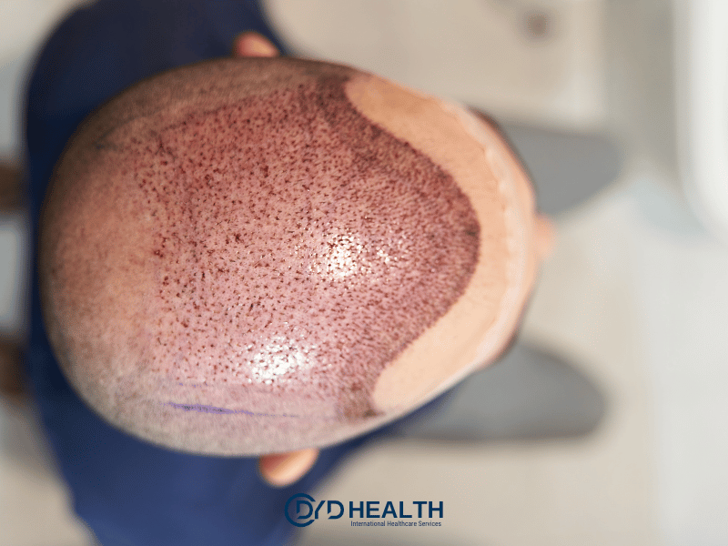 Robotik Sa&ccedil; Ekimi İşlemleri