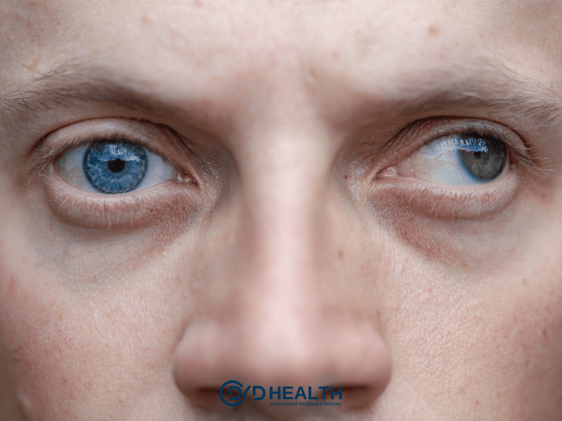 Şaşılık Tedavisi