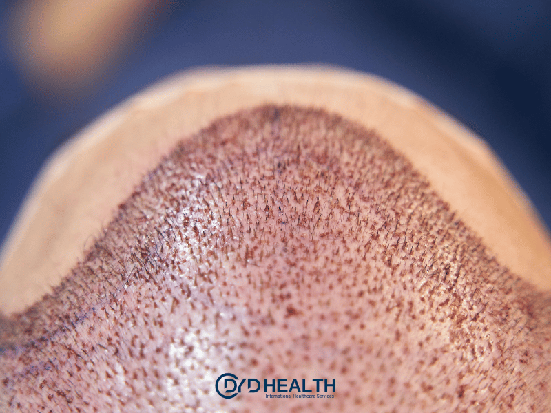 FUE Sa&ccedil; Ekimi İşlemleri